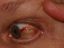 Infection-Blood-eye-1